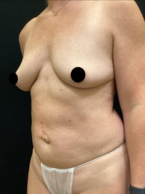 Breast Augmentation