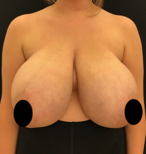 Breast Reduction