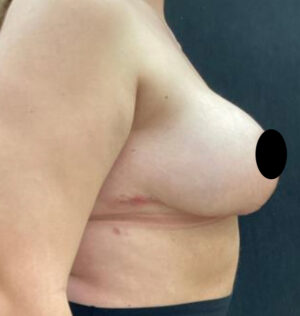 Breast Reduction