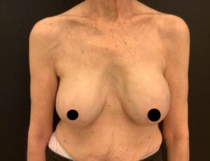 Breast Implant Removal