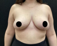 Breast Reduction