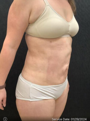 Liposuction