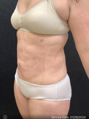 Liposuction