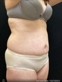 Liposuction