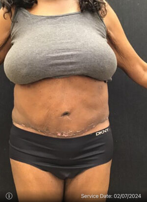 Tummy Tuck