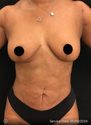 Breast Lift