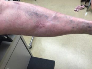 Squamous Cell Carcinoma