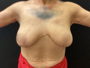 Breast Reduction