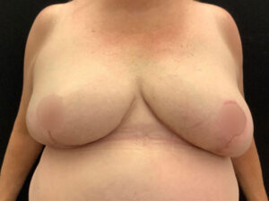 Breast Reduction