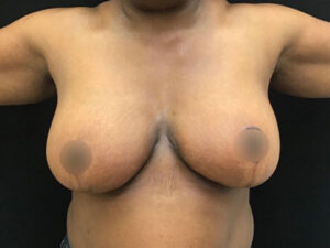 Breast Reduction