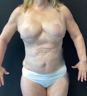 Breast Reduction