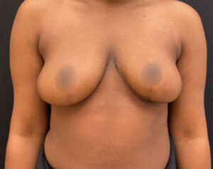 Breast Reduction