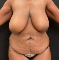 Breast Lift