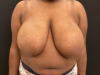 Breast Reduction