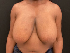 Breast Reduction