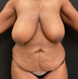 Breast Reduction