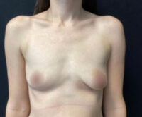 Breast Augmentation
