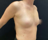 Breast Augmentation