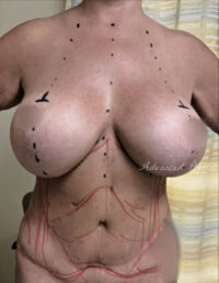 Breast Implant Removal