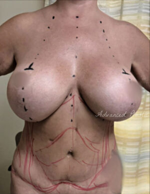 Breast Implant Removal