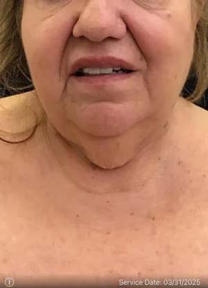 Neck Lift