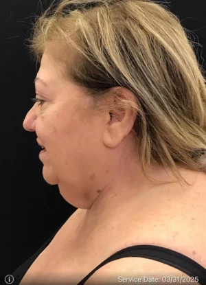 Neck Lift