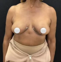Breast Reduction