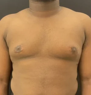 Gynecomastia