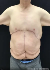 Panniculectomy