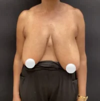 Breast Reduction