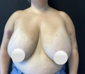 Breast Reduction
