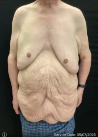 Panniculectomy