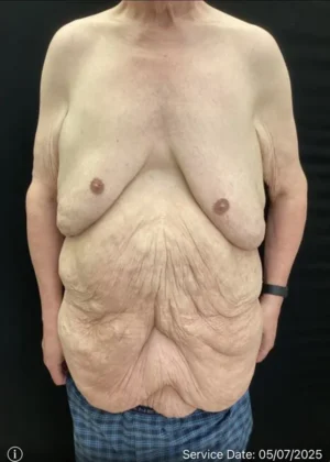 Panniculectomy