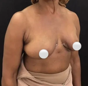 Breast Reduction