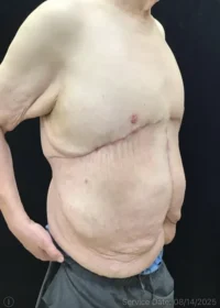 Panniculectomy