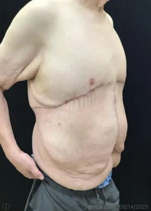 Panniculectomy