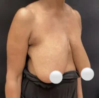 Breast Reduction