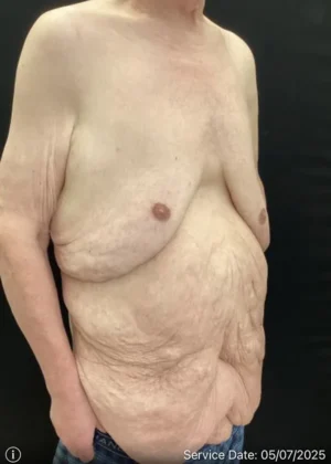 Panniculectomy