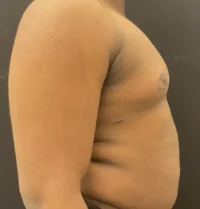Gynecomastia