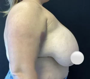 Breast Reduction