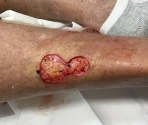 Basal Cell Carcinoma