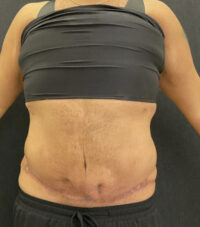 Tummy Tuck