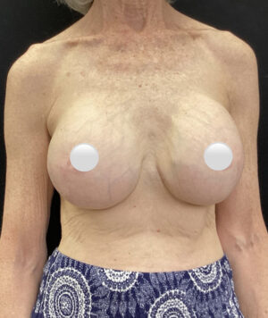 Breast Implant Removal