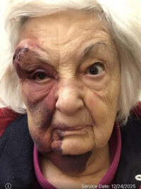 Facial Reconstruction