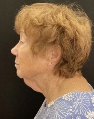 Neck Lift
