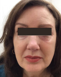 Basal Cell Carcinoma