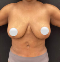 Breast Implant Removal