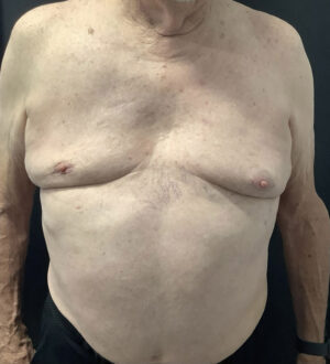 Gynecomastia