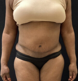 Panniculectomy