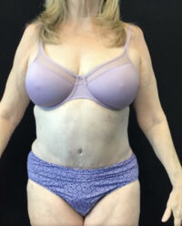 Tummy Tuck